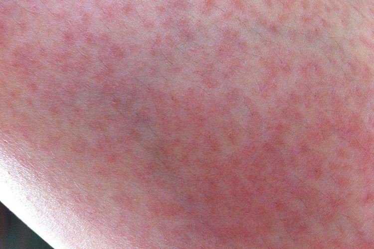 荨麻疹红疹图