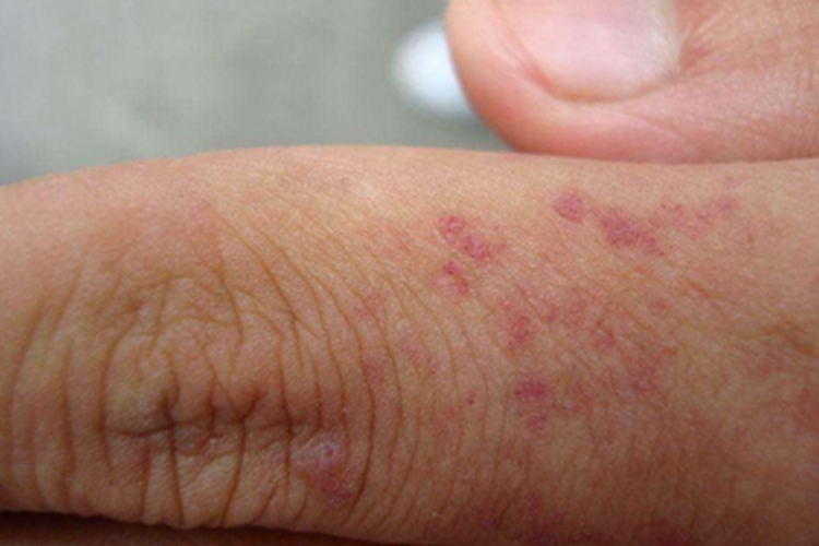 血管角化瘤长红斑图 血管角化瘤长红斑图