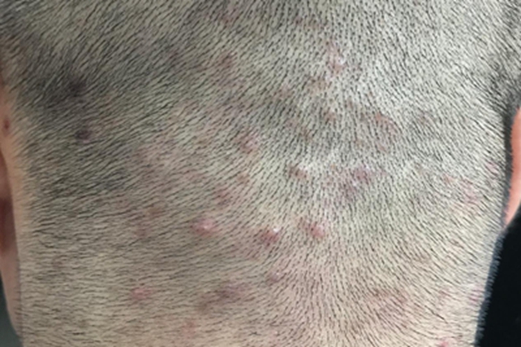 毛囊炎长硬包图片