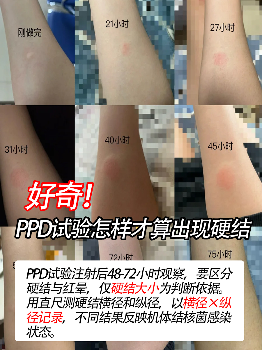 好奇！PPD试验怎样才算出现硬结