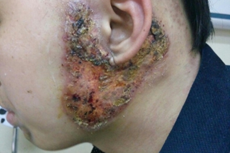 坏疽性脓皮病耳周溃疡图 坏疽性脓皮病耳周溃疡图