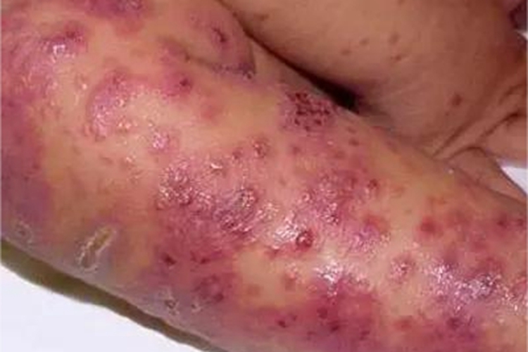 重型多形红斑型药疹小腿症状图 重型多形红斑型药疹小腿症状图