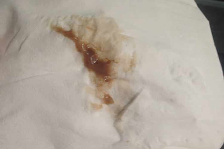 异位妊娠流褐色分泌物图