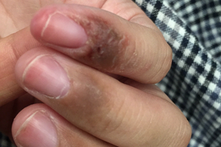 炎症后色素沉着手指症状图