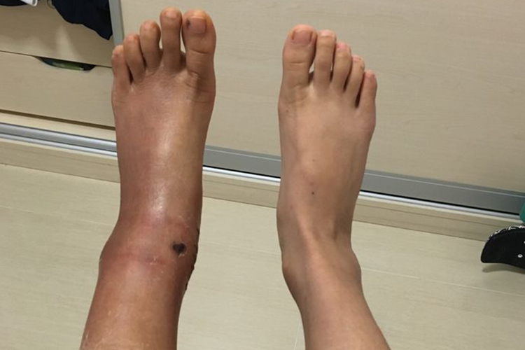 脚踝骨折肿胀图