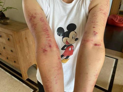 外伤皮肤上紫点点图