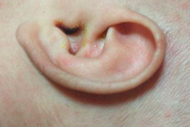 外耳湿疹外耳道结痂图