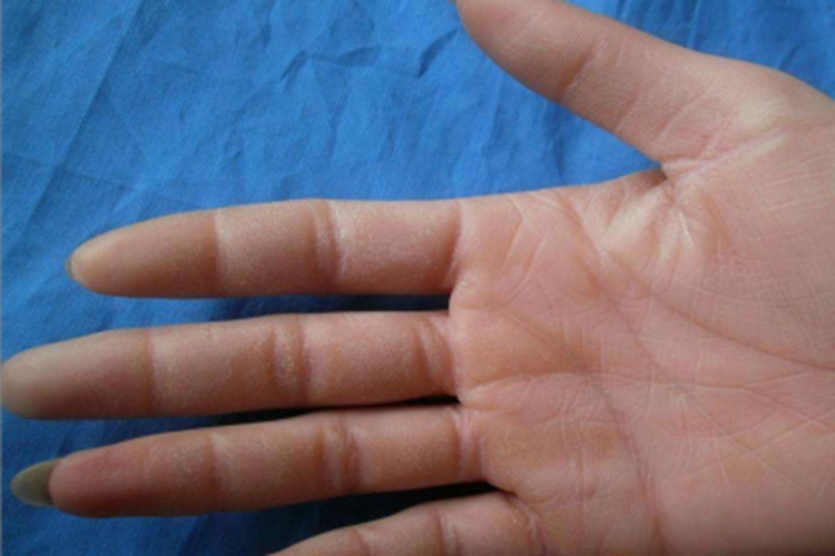 更年期角皮症手掌皮肤增厚图