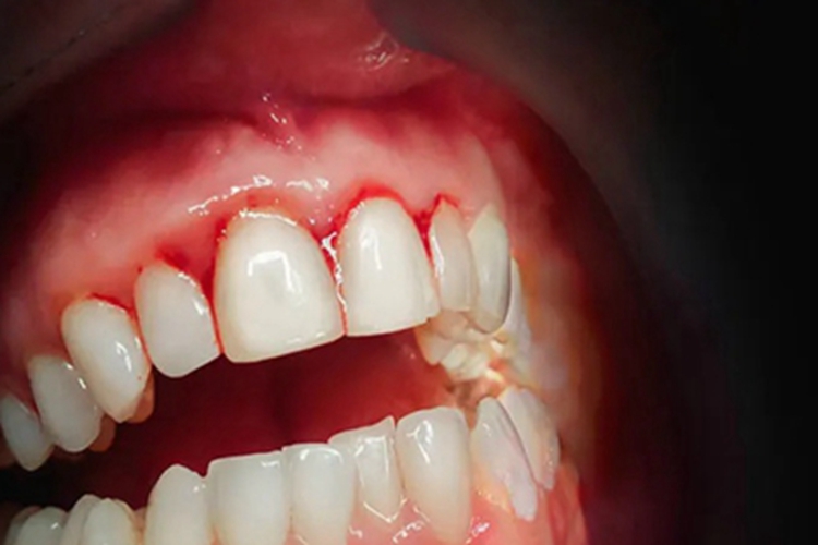 维生素c缺乏症牙龈症状图