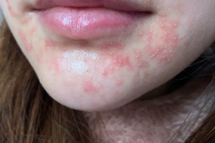 药物过敏性口炎口周症状图 药物过敏性口炎口周症状图