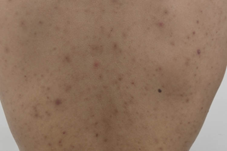 马拉色菌毛囊炎背部包块图 马拉色菌毛囊炎背部包块图