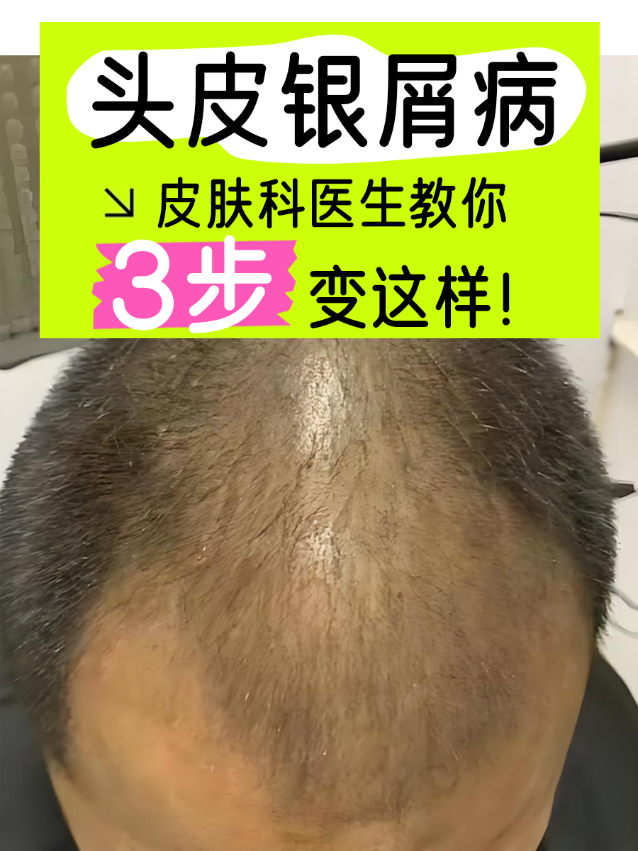 头皮银屑病怎么办？皮肤科医生教你科学应对