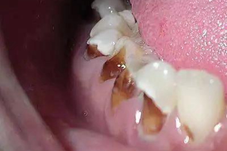 酸蚀症牙齿黄斑图