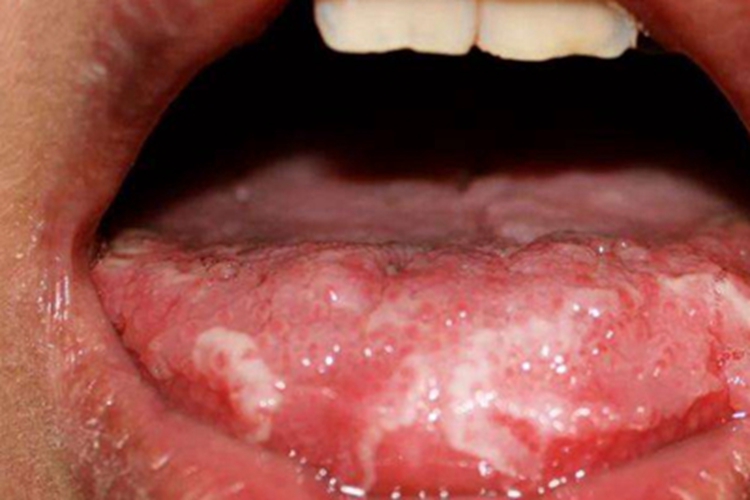 舌癌舌头表面多处溃烂发白图