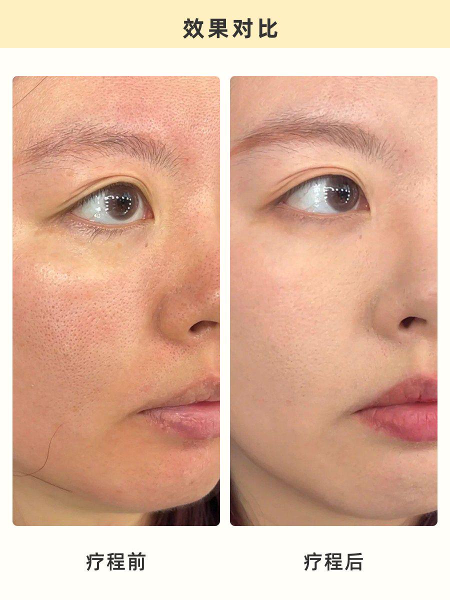 杭州黄金微针攻略：美肤界的“全能选手”！
