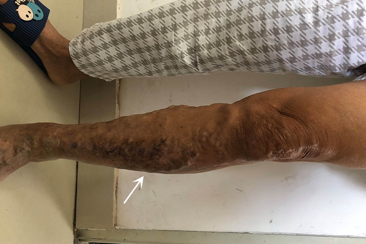 Ⅲ度静脉曲张图 Ⅲ度静脉曲张图