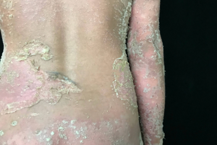 泛发性脓疱型银屑病全身脱皮图