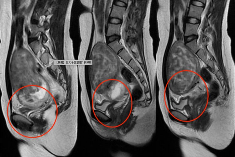 子宫肌瘤压迫膀胱图