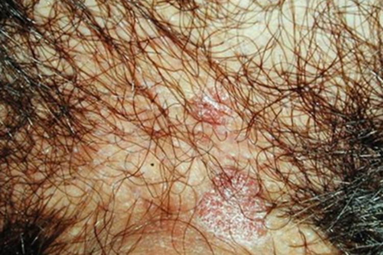 鲍温样丘疹病阴茎症状图