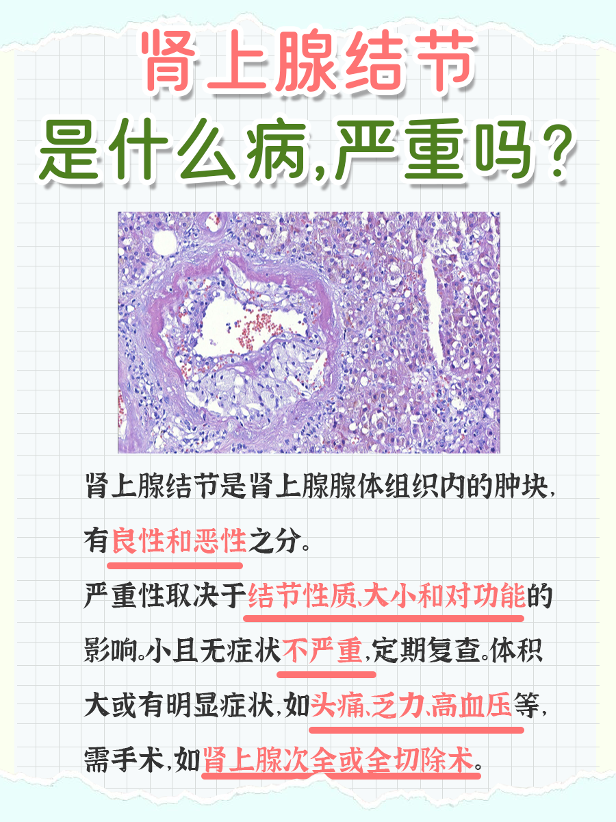 带你了解，肾上腺结节是什么病严重吗