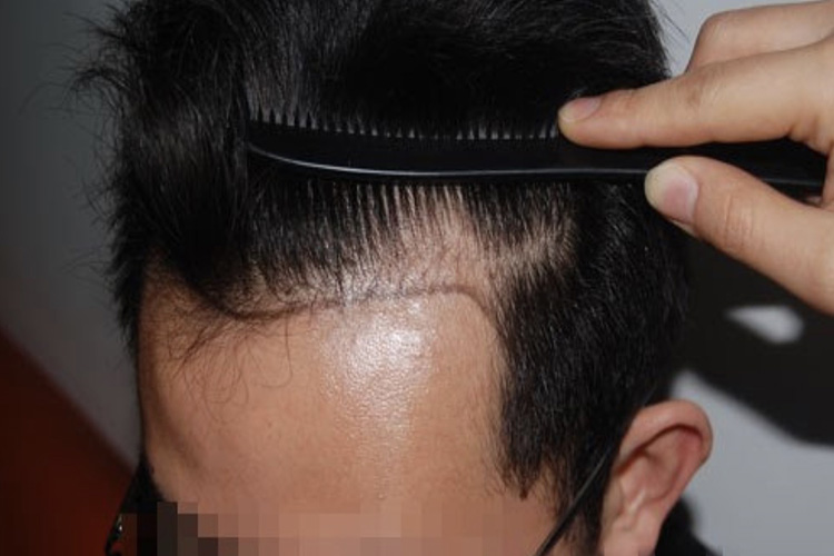 男性脂溢性脱发Ⅰ级图 男性脂溢性脱发Ⅰ级图