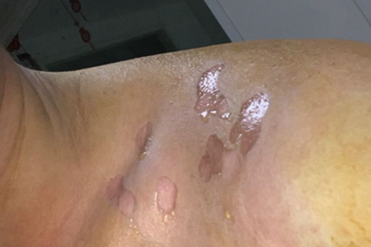 烫伤肩部渗液图