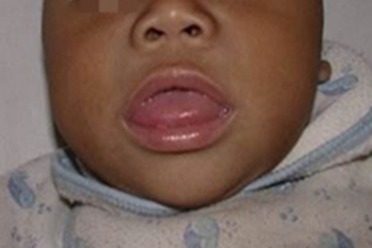 地方性克汀病头大舌头外伸图 地方性克汀病头大舌头外伸图