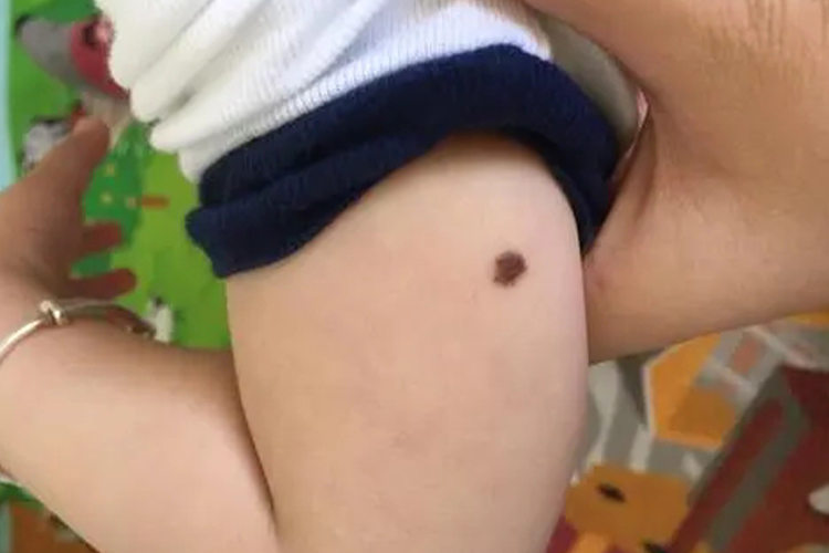 儿童痣细胞痣图 儿童痣细胞痣图