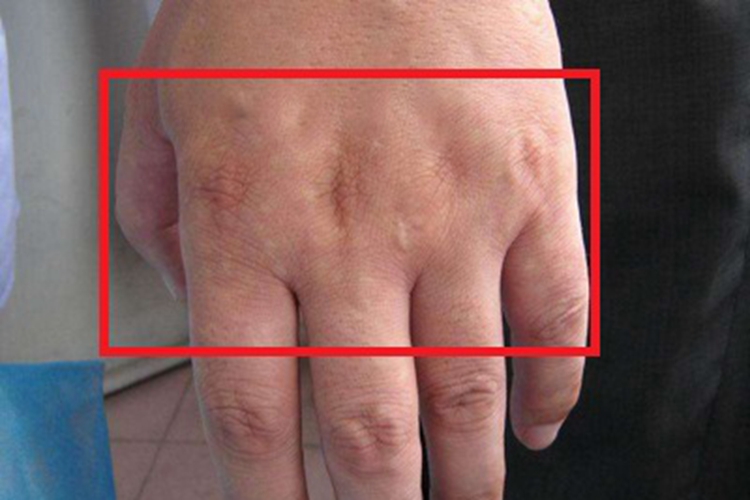 马歇尔-怀特综合征症状图