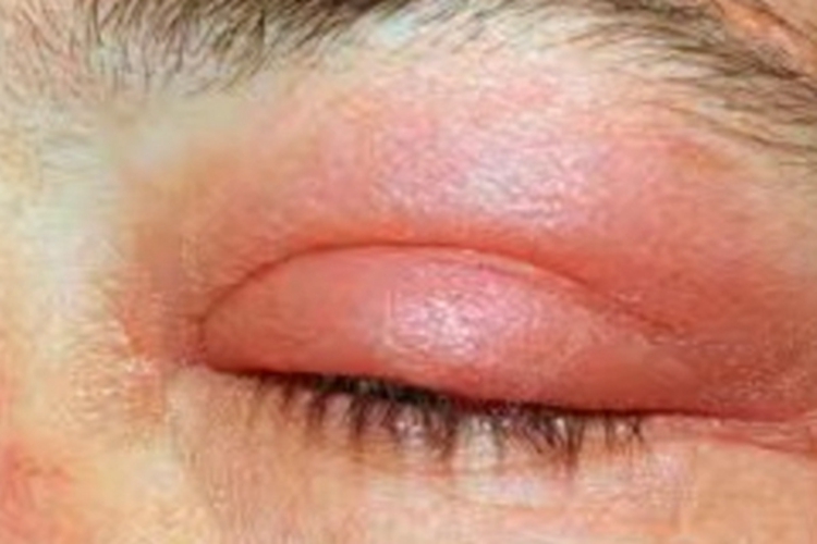 弥漫型类丹毒眼睑红斑图