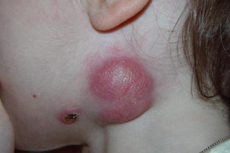 丝虫病急性期症状图