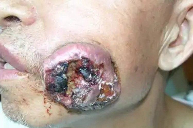 头部鳞状细胞癌面部症状图