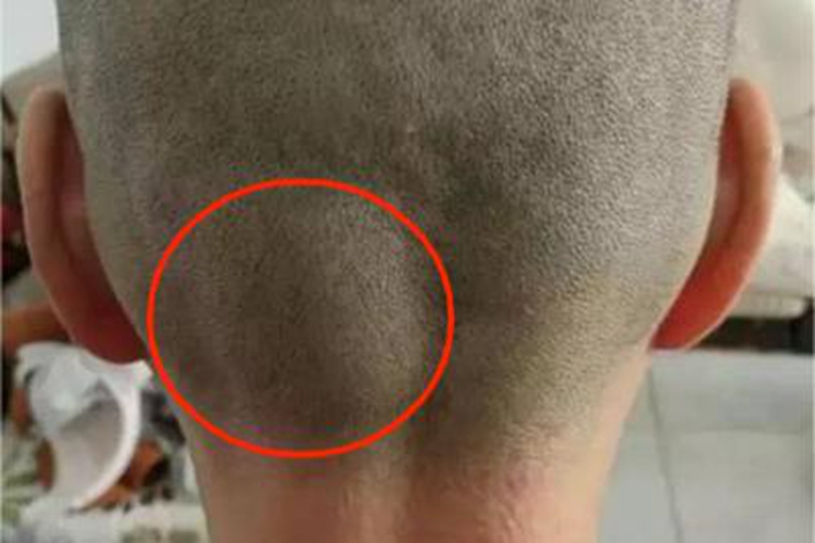 脂肪瘤后脑勺结节图