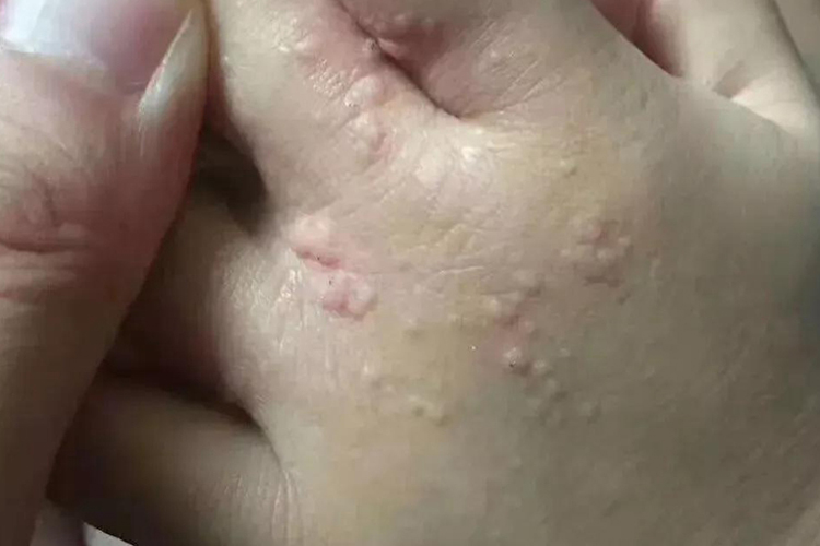 手部扁平疣图 手部扁平疣图