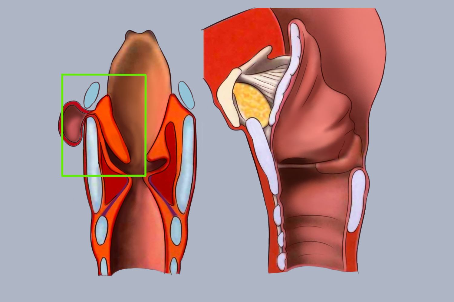 喉外型喉气囊肿图
