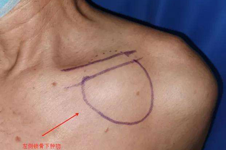 脂肪瘤图 脂肪瘤图