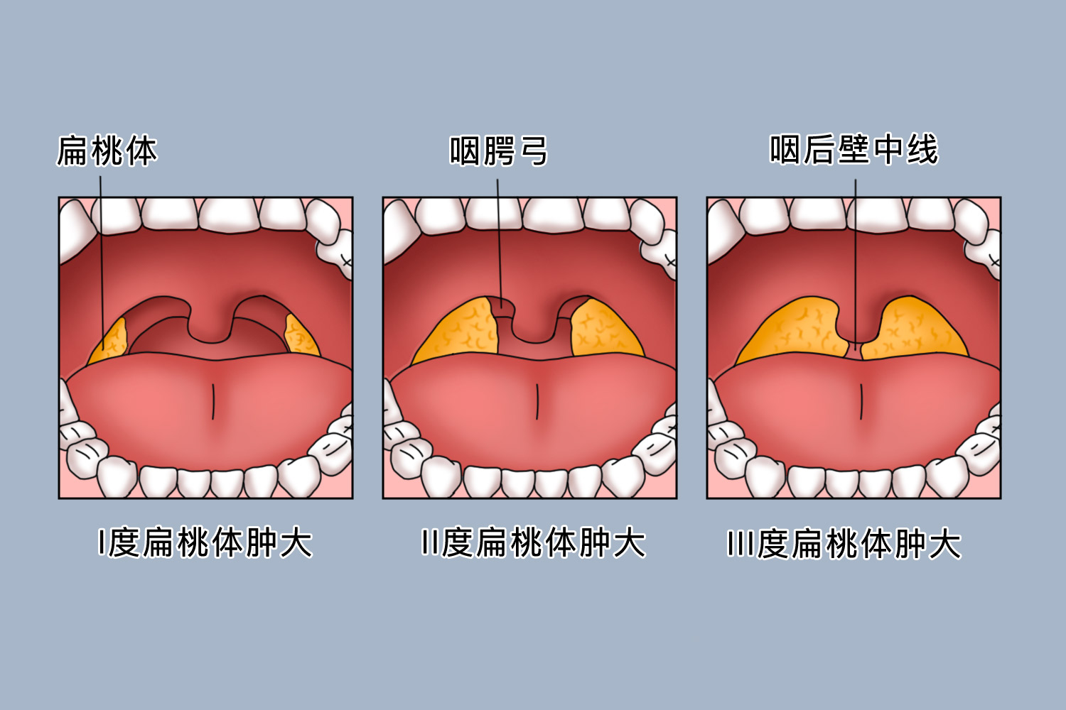 扁桃体肿大分度标准图 扁桃体肿大分度标准图