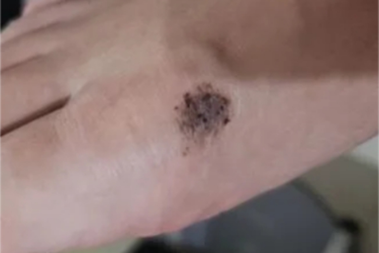 恶性雀斑样痣脚背黑斑图