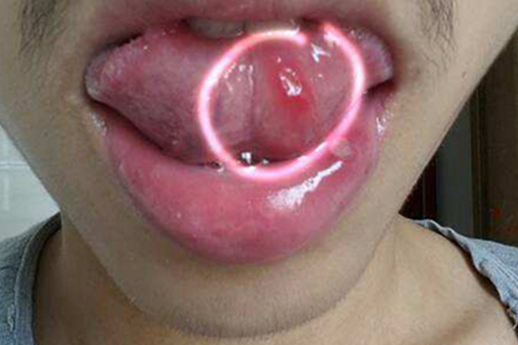 口腔溃疡图 口腔溃疡图