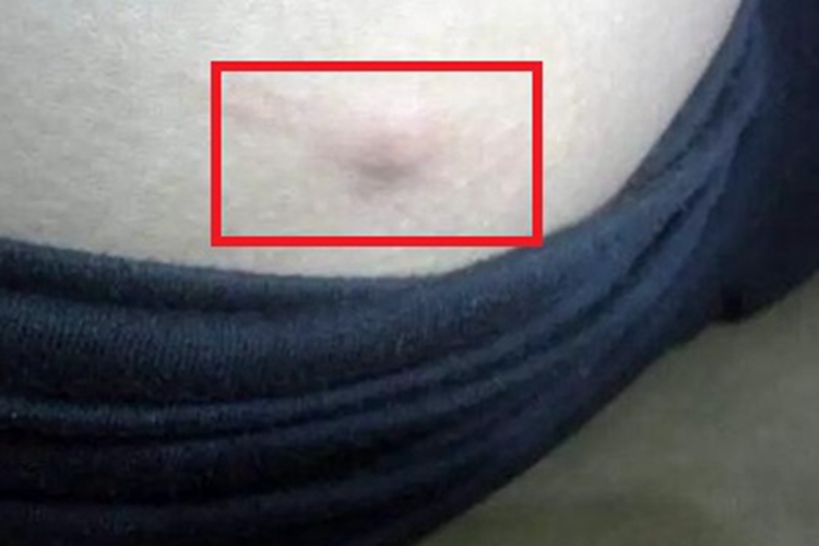 肚皮上长脂肪瘤图