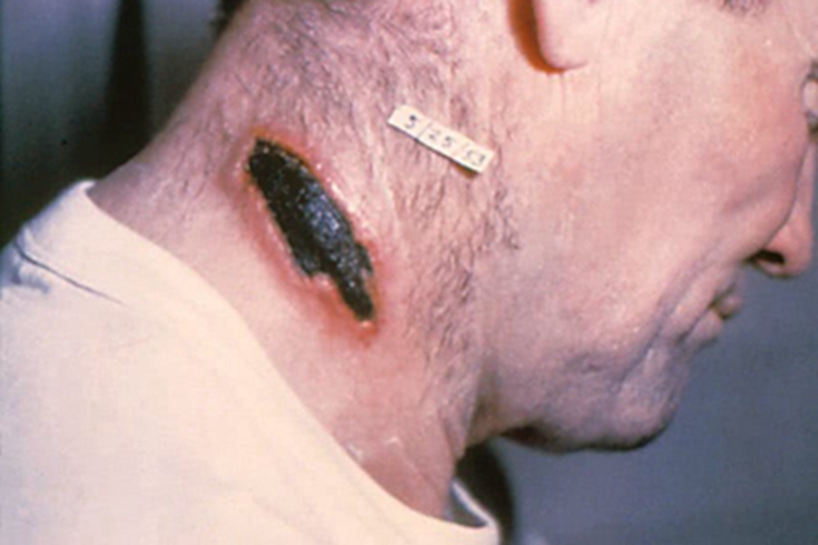 皮肤炭疽颈部结痂图