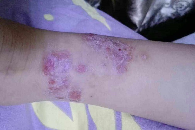 虫咬皮炎小腿脱皮图