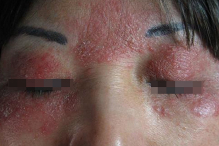 职业性光变应性接触性皮炎症状图