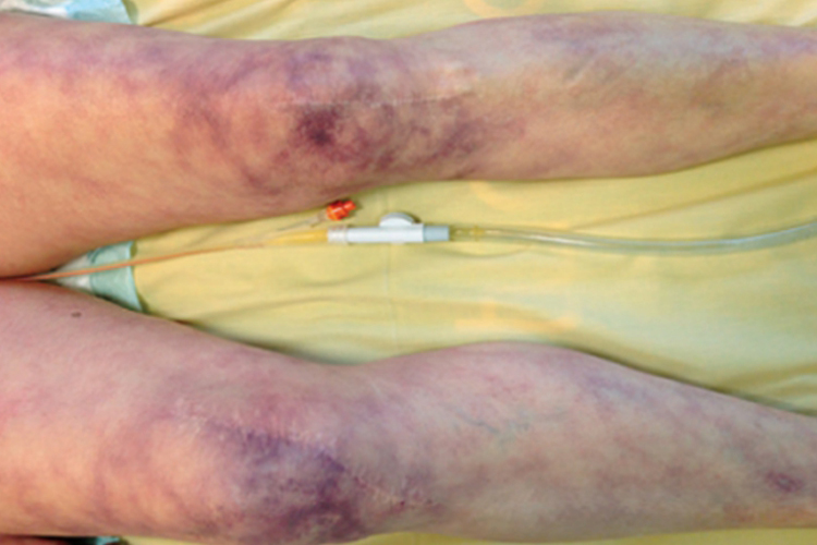 感染性休克皮肤发花图 感染性休克皮肤发花图