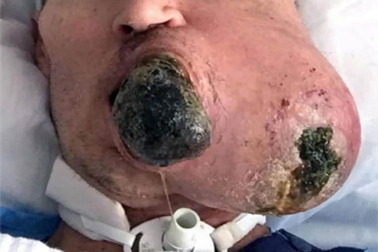 滑膜肉瘤面部症状图