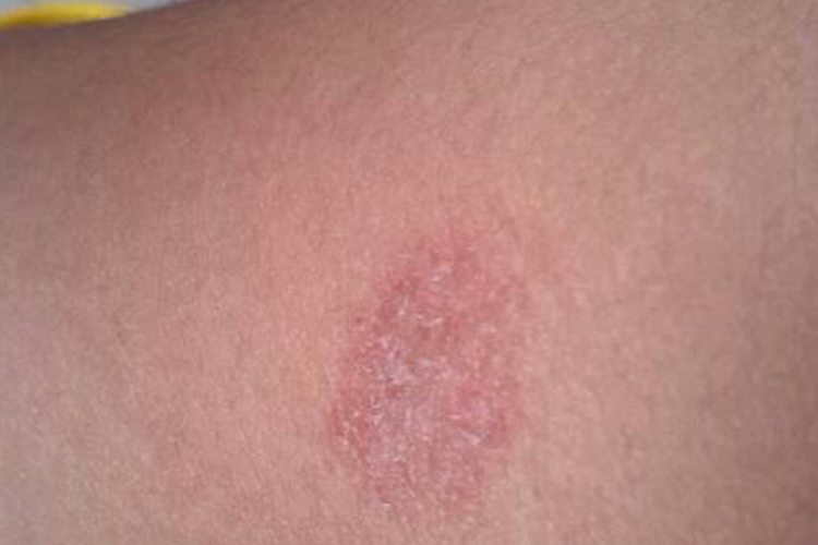 慢性期钱币状湿疹图