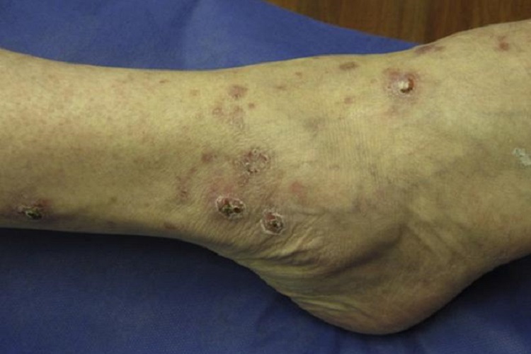 虫咬皮炎脚踝结痂图