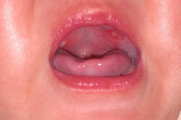 4个月宝宝口腔溃疡图