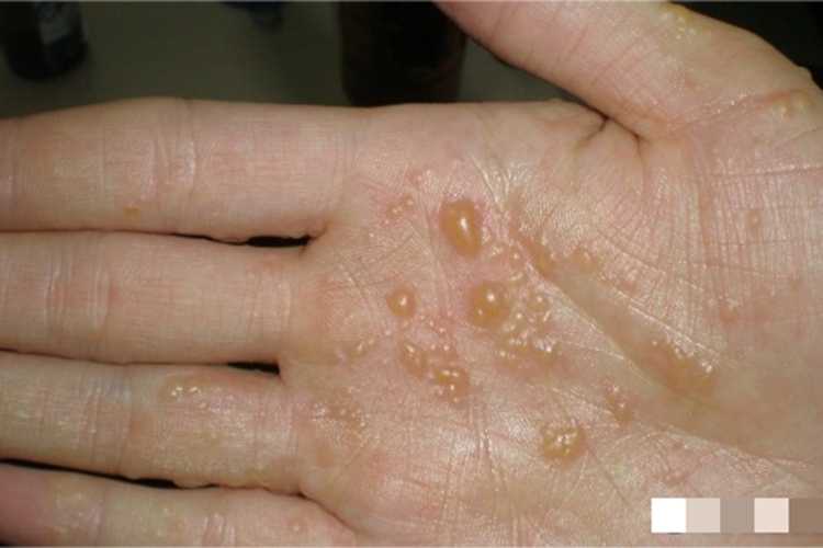 汗疱疹大水疱图