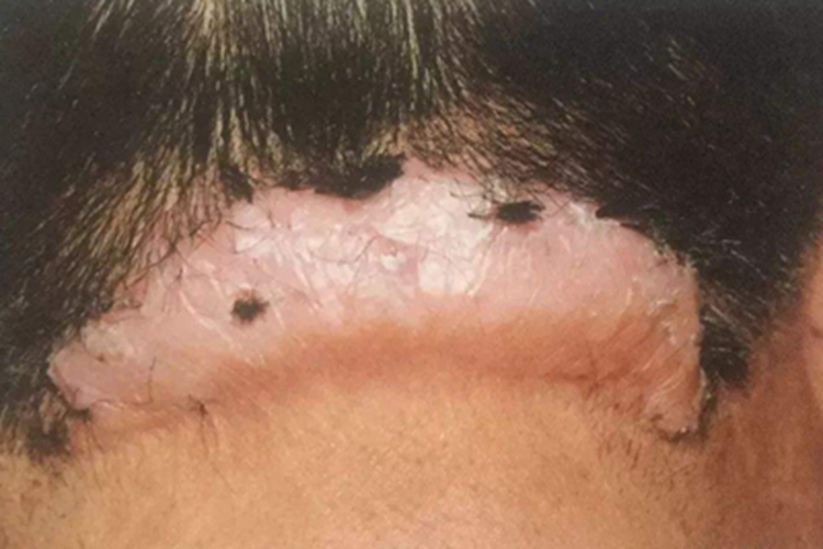 项部瘢痕疙瘩性毛囊炎颈部硬块图